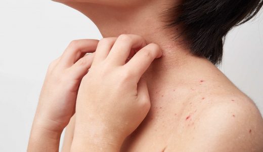 アトピー性皮膚炎の漢方治療とは？漢方薬の選び方やおすすめ養生法も解説